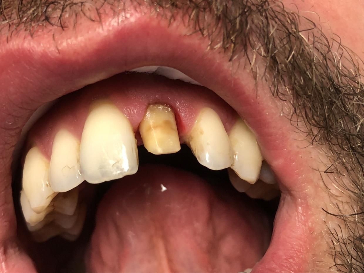 bocca in primo piano protesi fissa e mobile