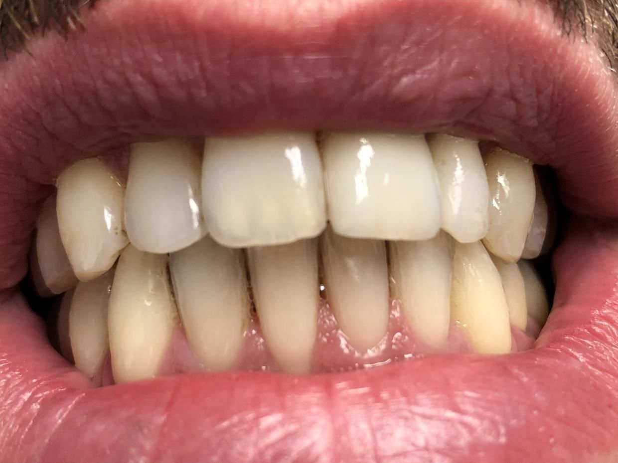 bocca in primo piano protesi fissa e mobile