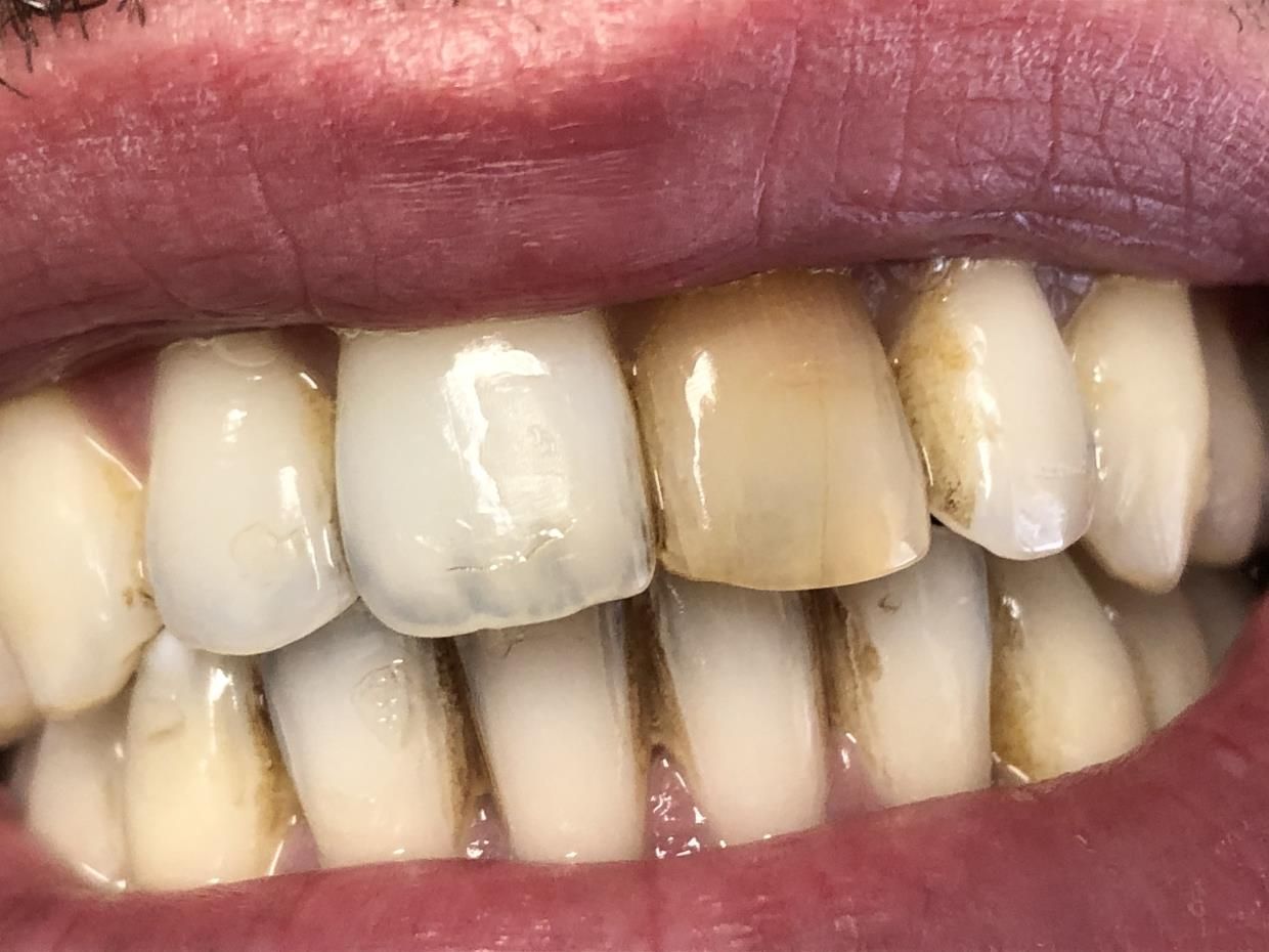 bocca in primo piano protesi fissa e mobile