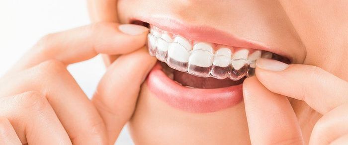 A woman is wearing invisible braces on her teeth.