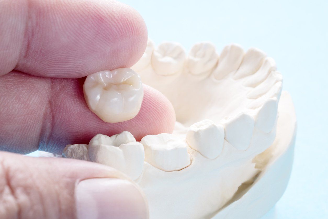 A person is holding a dental crown in their hand over a model of teeth.