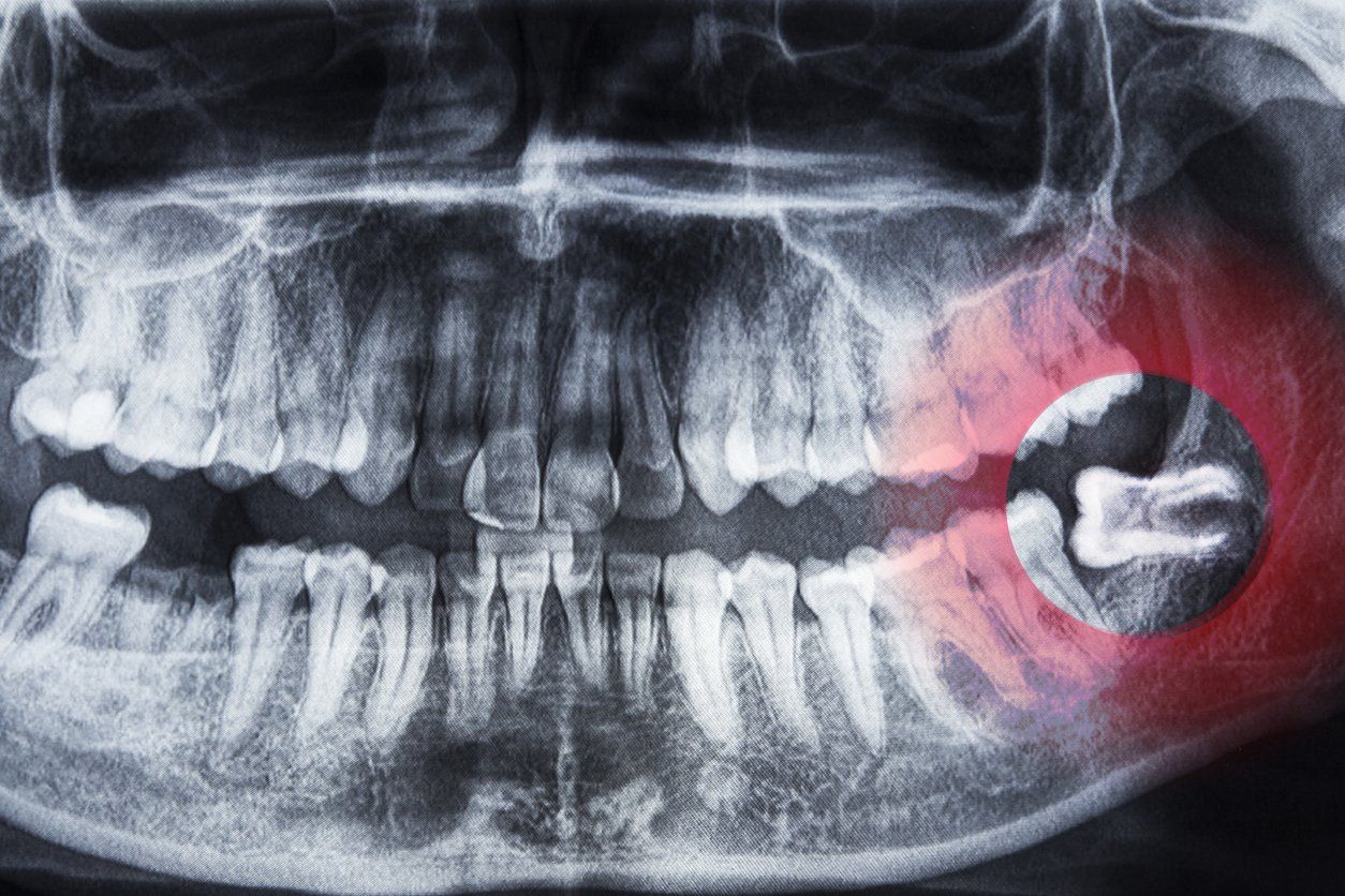 An x-ray of a person 's teeth showing a wisdom tooth.