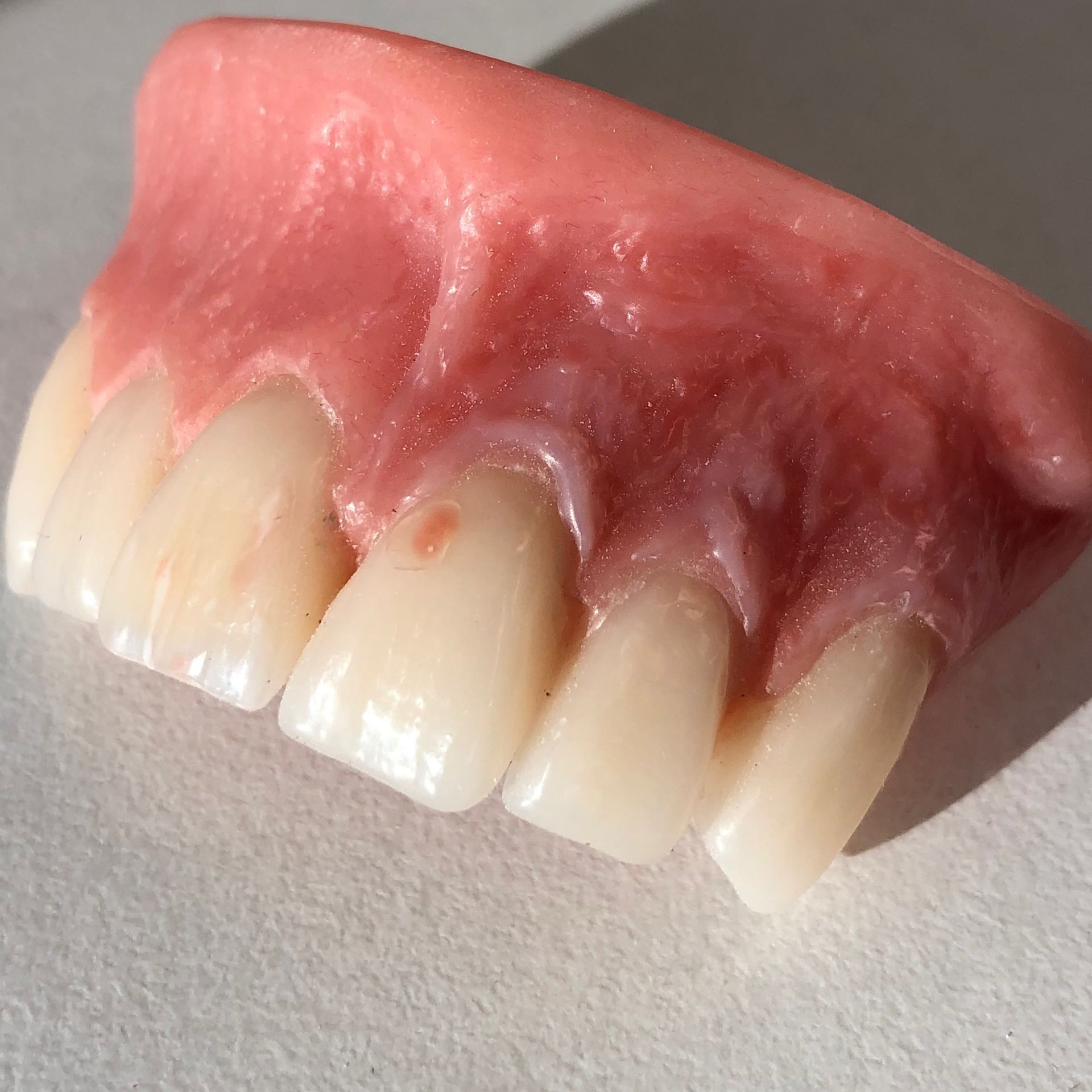 Partial Denture, Pink Gum, and White Teeth — My Denture Clinic in Tamworth, NSW