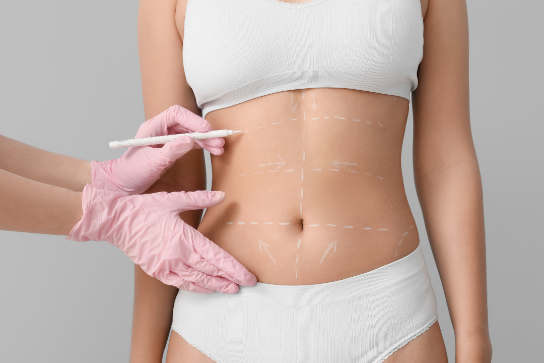 Una persona está recibiendo acupuntura en la espalda.