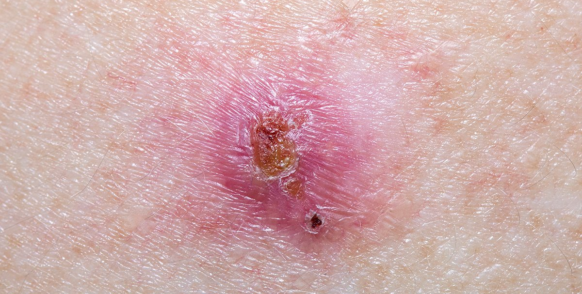 What is a Basal Cell Carcinoma?