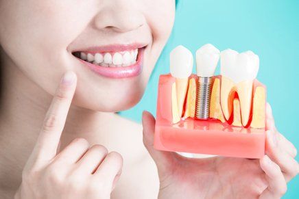 Dental Implants