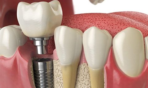 Teeth Dental Implant — Washington, PA — Snee Dental Associates