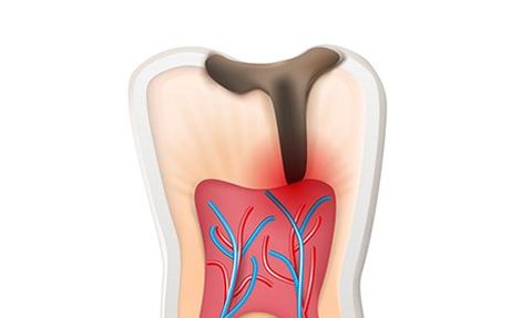 Tooth Decay — Washington, PA — Snee Dental Associates
