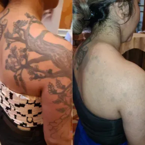 A before and after picture of a woman 's back with tattoos