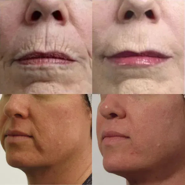 A woman 's face is shown before and after a procedure