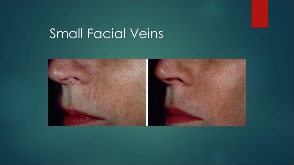 Two pictures of a woman 's face with small facial veins.