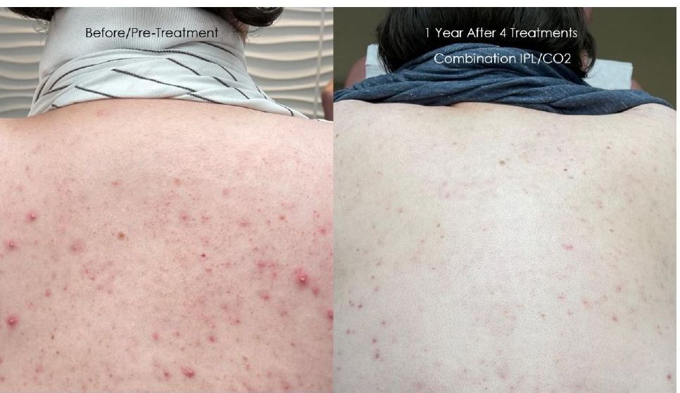 A before and after picture of a person 's back with acne.