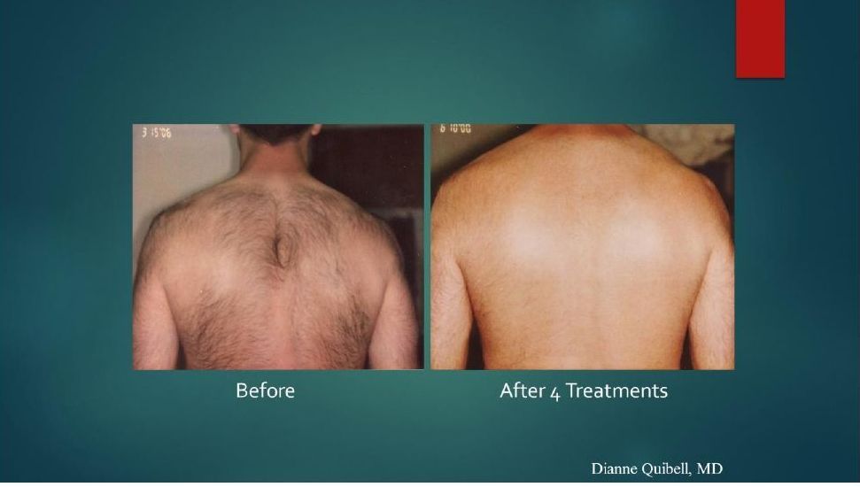 A before and after picture of a man 's back