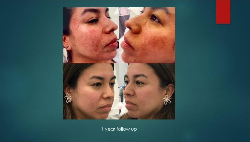 A before and after picture of a woman 's face with acne