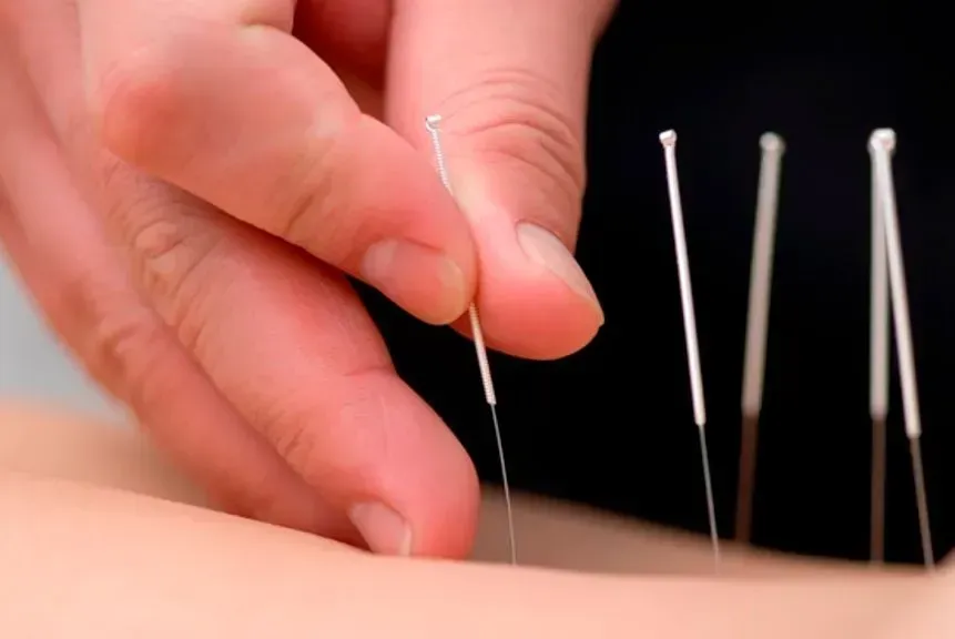 Hand placing an acupuncture needle into skin with several needles standing nearby