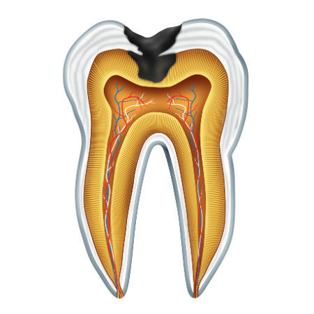 Teeth nerves, Hammond, IN