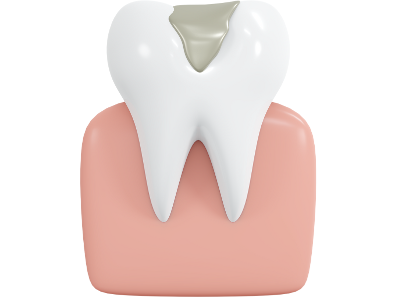 A 3d rendering of a tooth with a filling in it. Hammond, IN