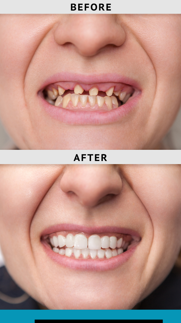 A before and after picture of a person 's teeth Hammond, IN