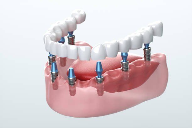 Dental Implant Demonstration — La Crosse, WI — Coulee Family Dental