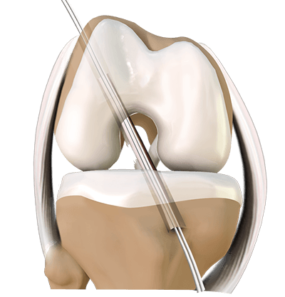 ITB Release  Sydney Orthopaedic Trauma & Reconstructive Surgery