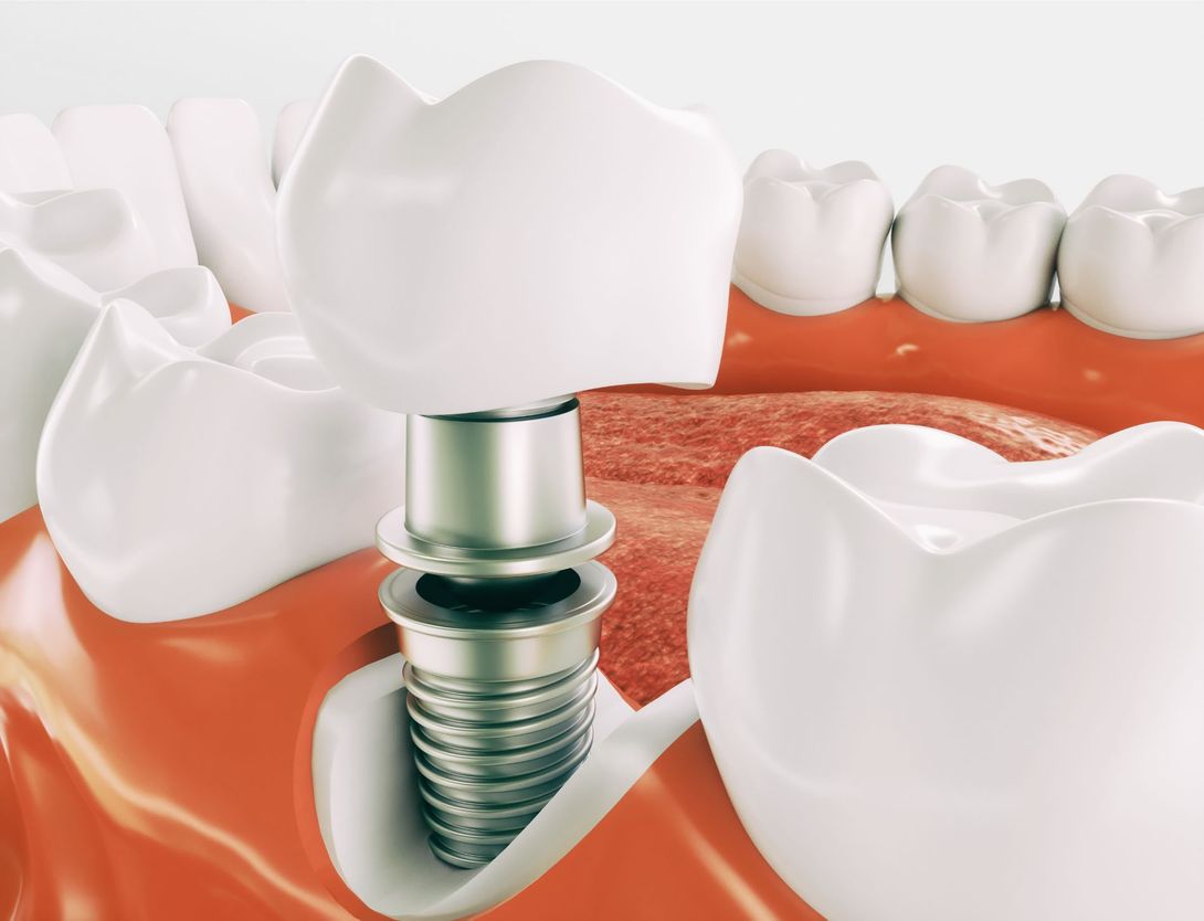 applicazione impianto dentale