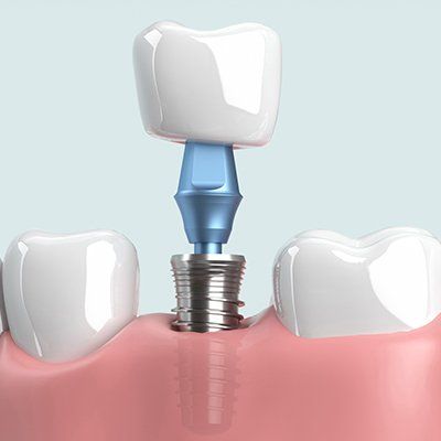 Dental Implants — Newton, SA — Arena Dental