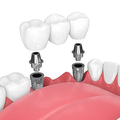 Crowns & Bridges Treatment — Newton, SA — Arena Dental
