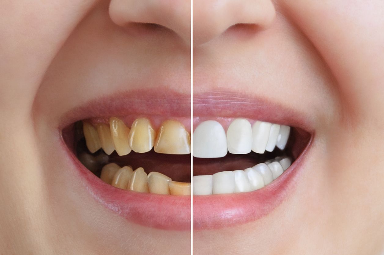 A before and after picture of a woman 's teeth.