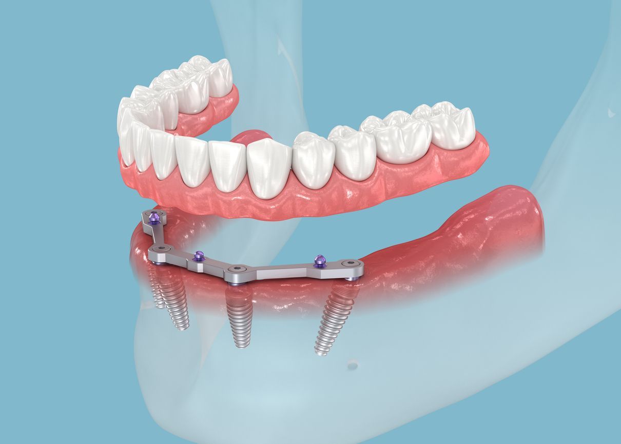 A computer generated image of a full denture with dental implants.