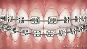 traditional metal braces