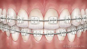 clear braces