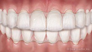 aligners