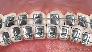 lingual braces