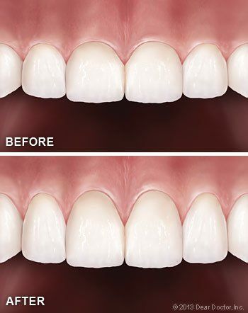 gum surgery before and after