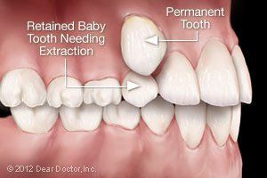 teeth extraction 
