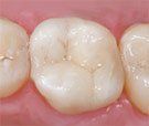 tooth colored filling result