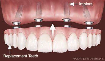 implants and replacement teeth