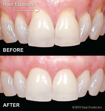 gum grafting before and after