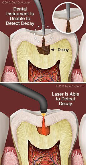 laser detecting decay