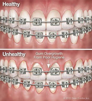 Swollen gums while wearing braces