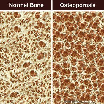 normal bone and osteoporosis