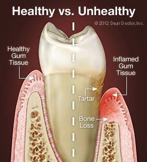 healthy vs unhealthy gum tissue