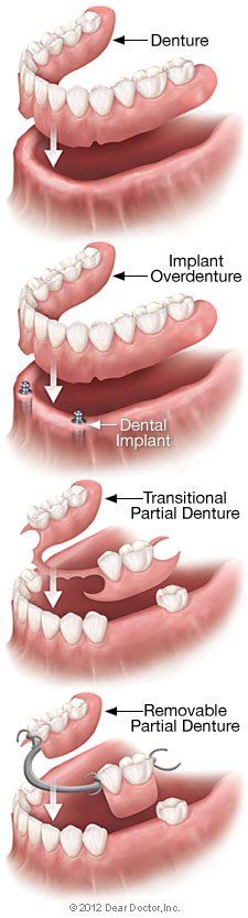 types of dentures
