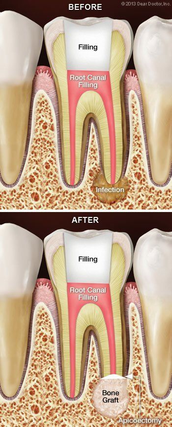 before and after dental fillings