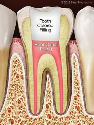 root canal