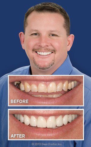 man smile before and after