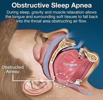 sleep apnea