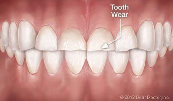 tooth wear