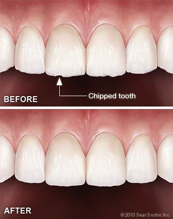 chipped tooth before and after