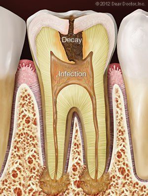 tooth decay and infection